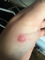 AIBU to ask whether these bites need checking by a doctor?