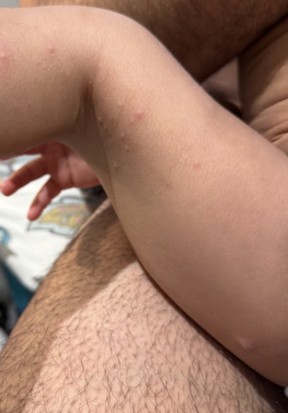 Is this chicken pox? Or something else?