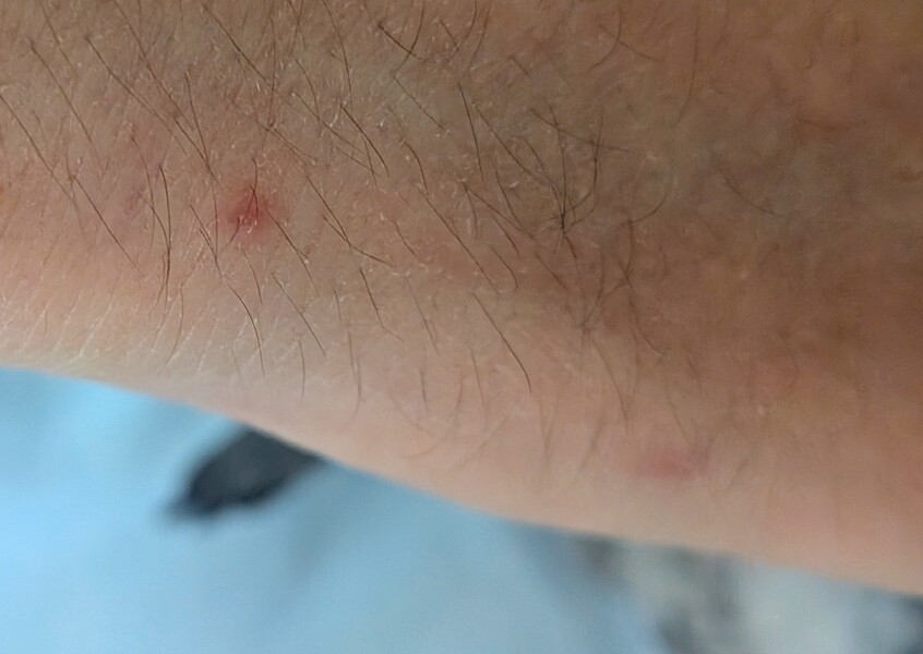 Small itchy spots on side of hand