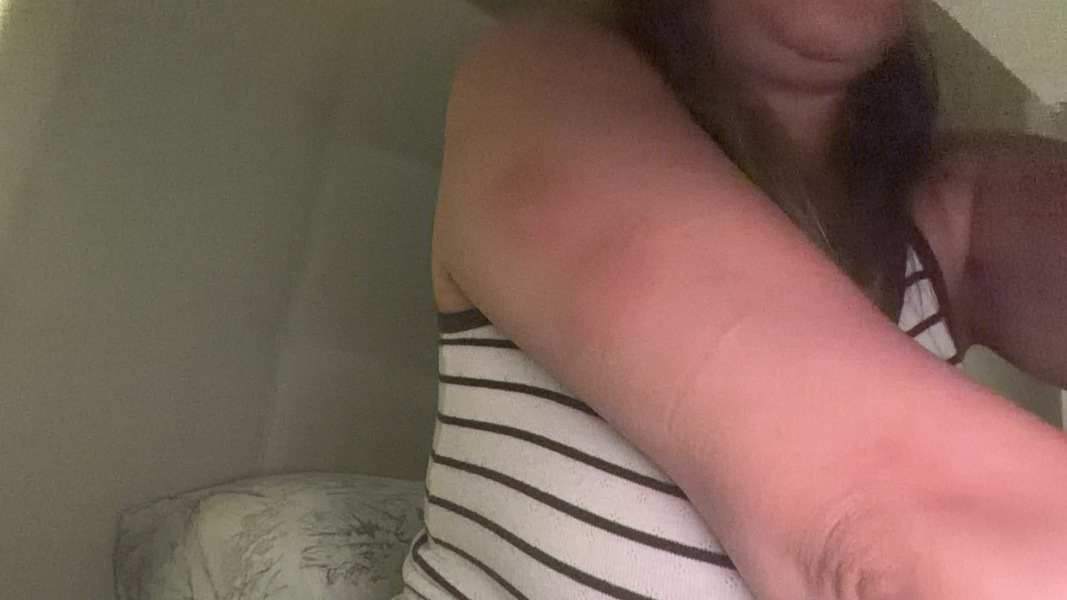 Is anyone in the UK getting lots of insect bites at the moment?