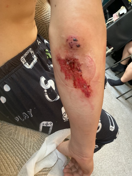 How to heal scrapes and grazes???