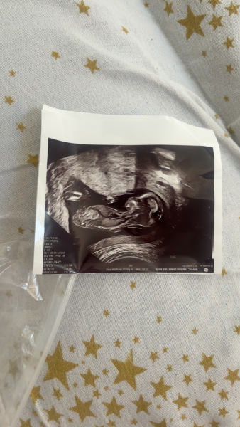 Can anyone guess the baby’s sex from this pregnancy?
