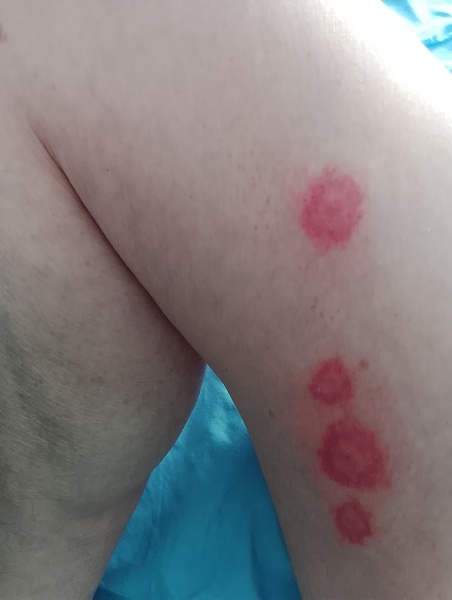 Bed bugs in hotel.