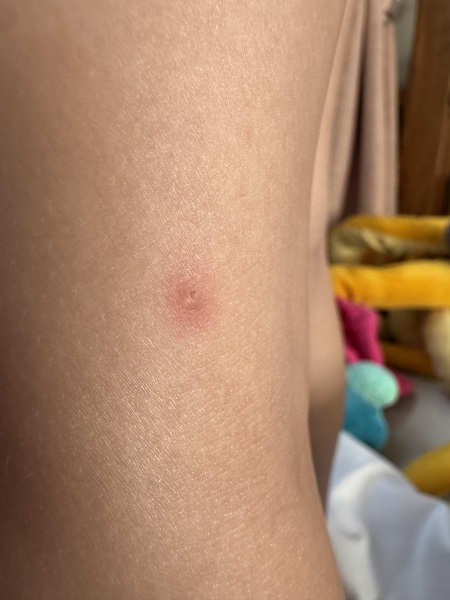 Two year old keeps getting unexplained spots