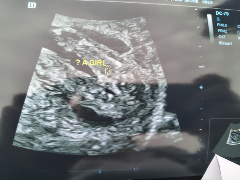 17 week gender scan suggests girl but baby kept legs crossed