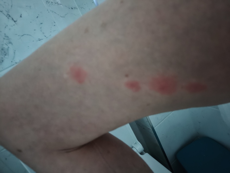 Bed bugs in hotel.