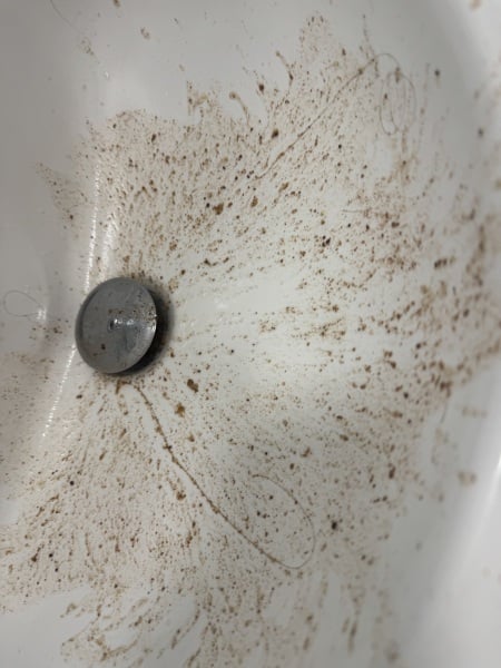 Any medical professionals awake please? Young adult daughter far from home on own with severe headache and worrying photo (sensitive image). Possible coffee ground emu.