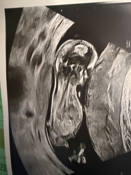 Can anyone guess baby’s sex from my 13 week scan however? Please read my message