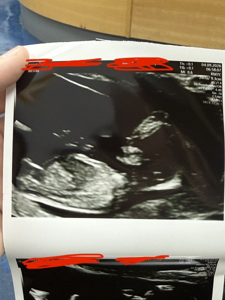 Any guesses on baby's sex from the nub scan?
