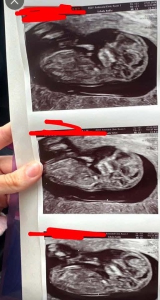 How relevant is bladder position when predicting sex at 12 weeks? High bladder - Girl?! 🩷