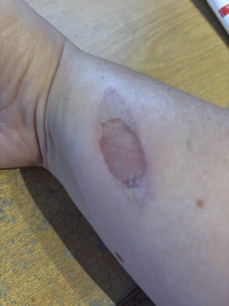 Is my son's small hot oil burn safe to manage at home?