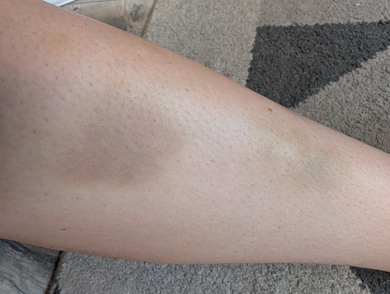 Random bruising again after normal blood tests, should I return to GP?