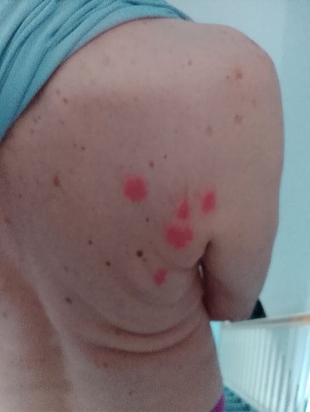 Bed bugs in hotel.