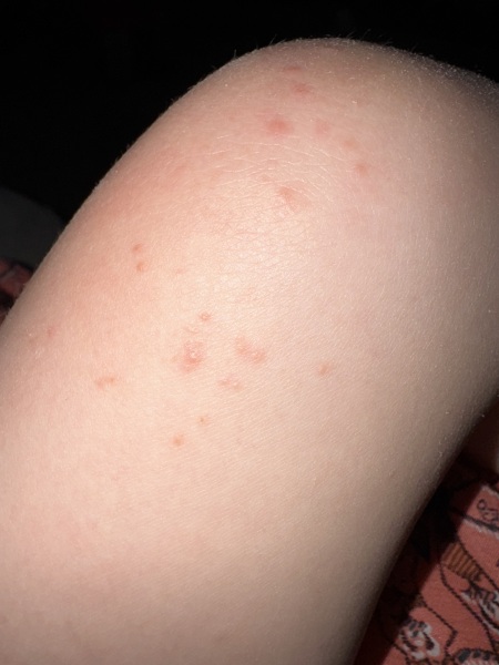 Two year old keeps getting unexplained spots
