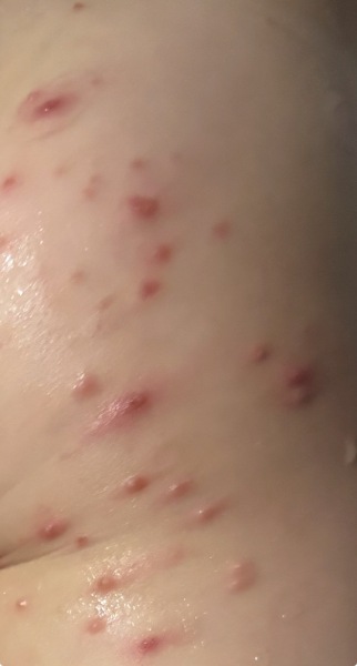 Molloscum contagiosum