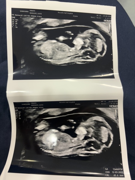12 week scan, does nub theory work? What's your guesses? :)