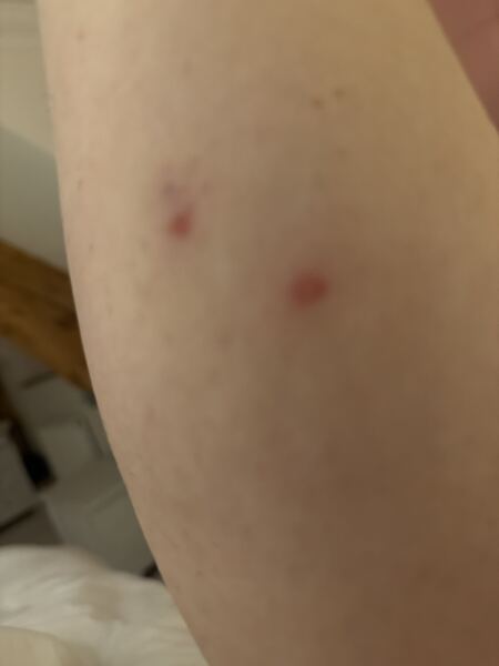 Is anyone in the UK getting lots of insect bites at the moment?