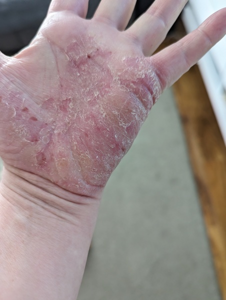 Advice for managing pompholyx eczema on hands
