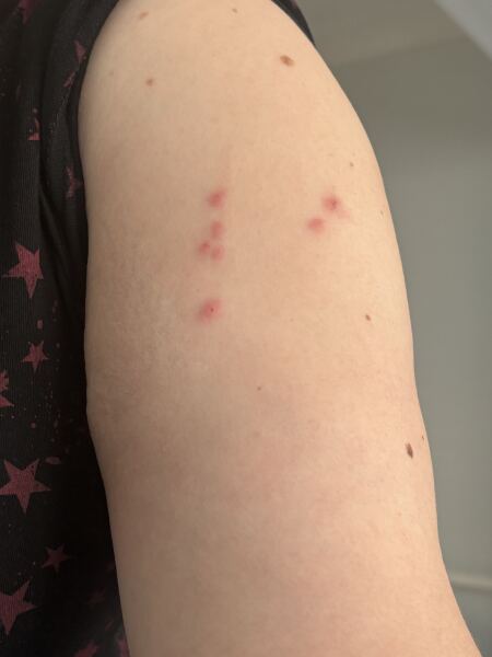 Bed bugs in hotel.