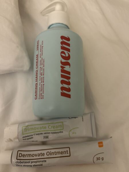Advice for managing pompholyx eczema on hands