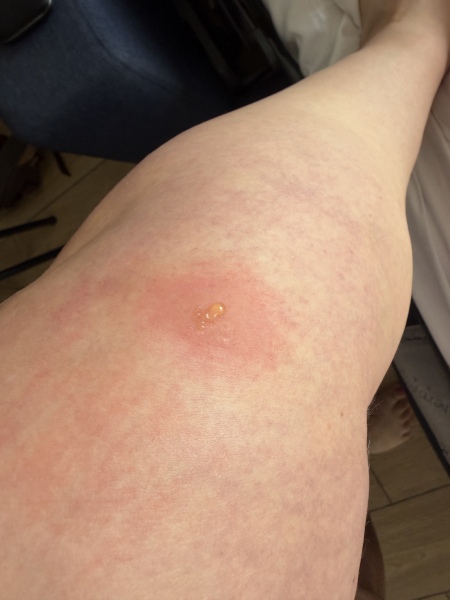 To ask for help with an infected bug bite?!