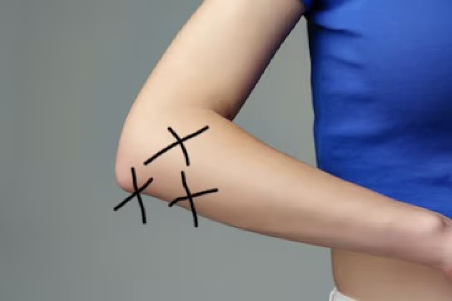 Anyone had similar outer elbow and forearm pain that will not ease?