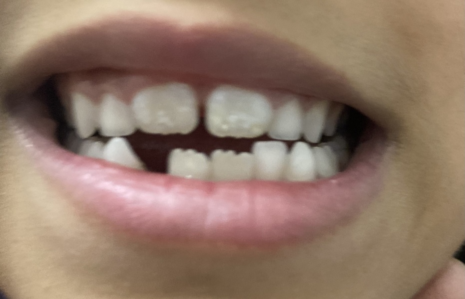 White spots on new front teeth after baby teeth fell out
