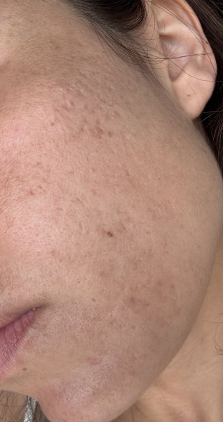 Would my skin benefit from microneedling or are there better options?
