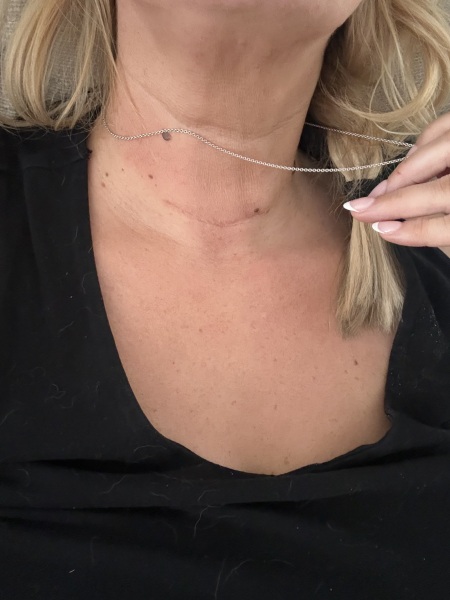 hemithyroidectomy