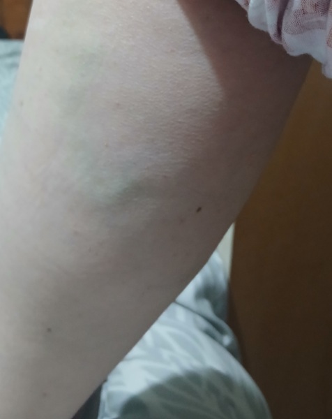 To worry about varicose veins?