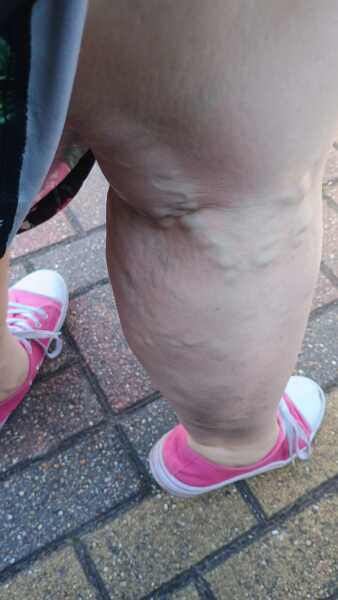 Varicose vein treatment on the NHS.
