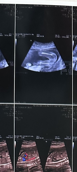 Potty shot 20 weeks! Boy or Girl guesses?