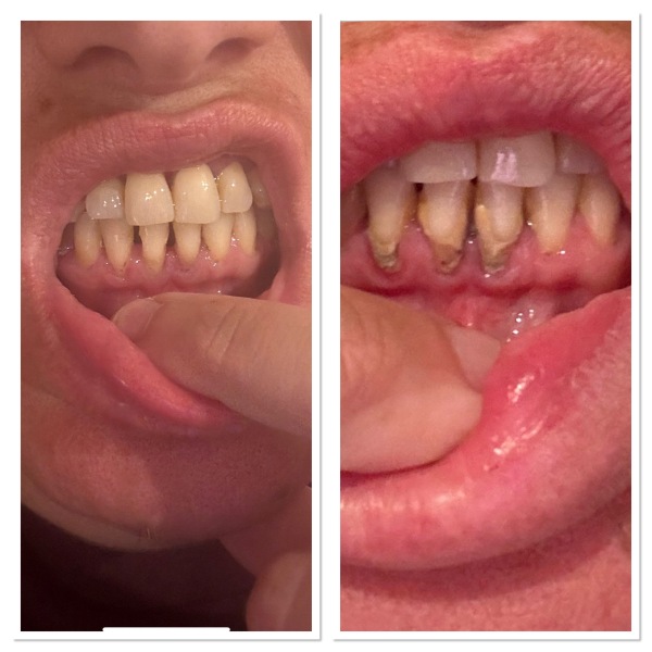 Ten years avoiding the dentist and finally had a scale and polish