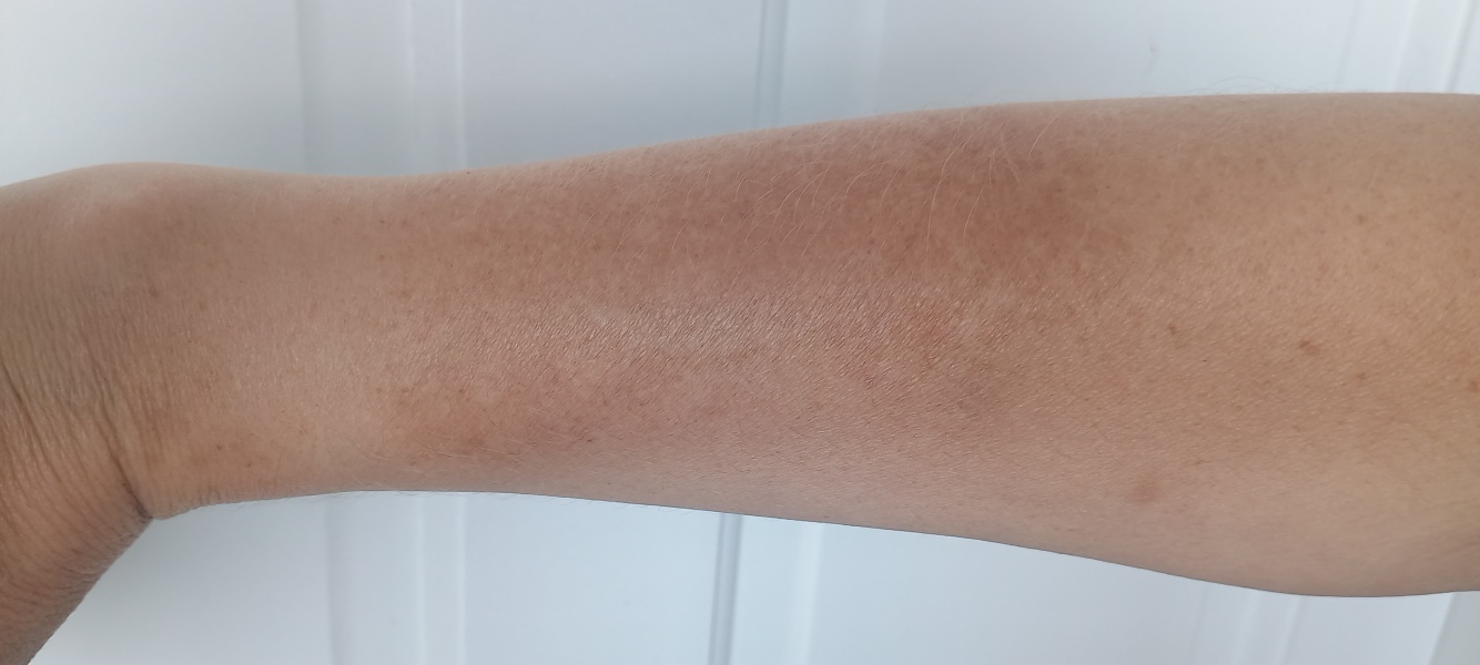 Melasma on arm, how to get rid of it?