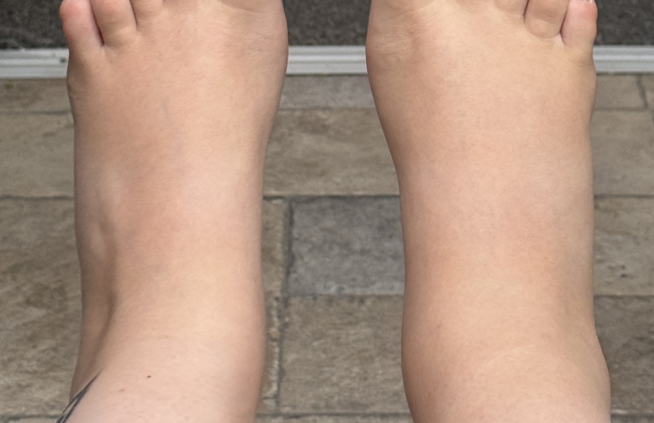 One ankle more swollen than the other in third trimester