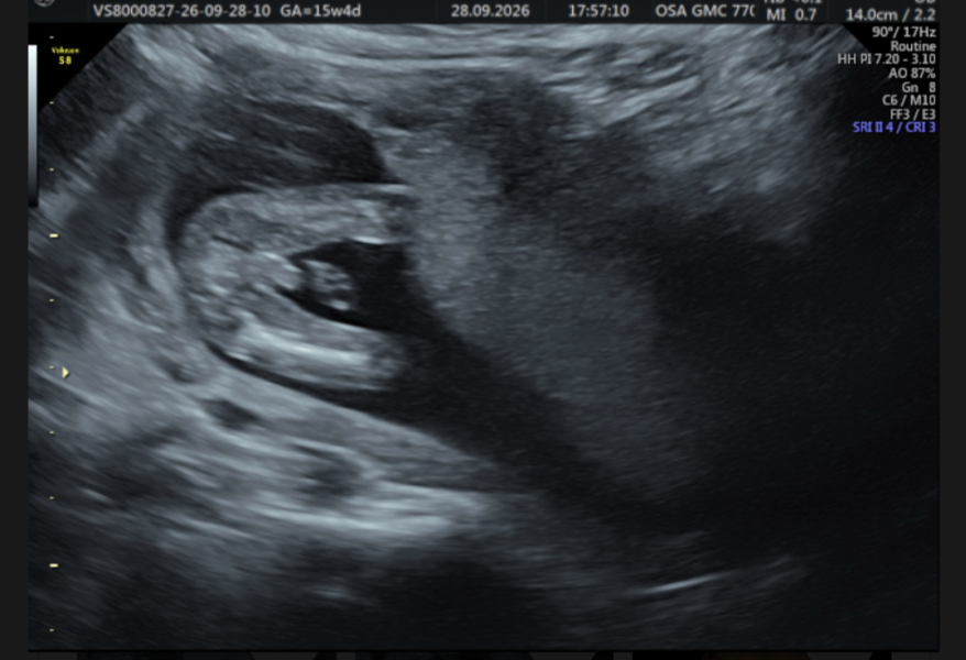 Boy or umbilical cord?