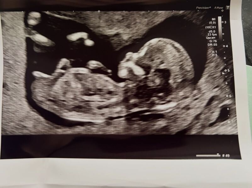 13 weeks and 1 day, boy or girl?