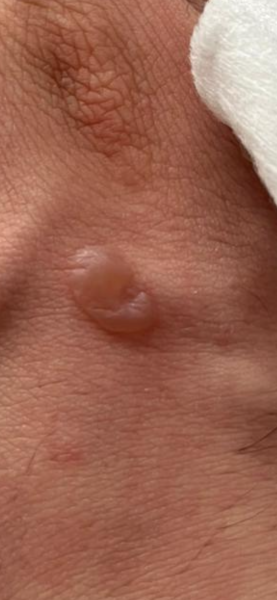Is my son's small hot oil burn safe to manage at home?