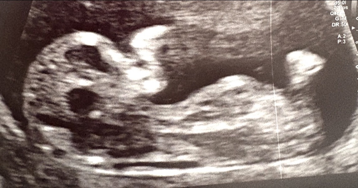 Any gender guesses from these pregnancy scans for our first baby?
