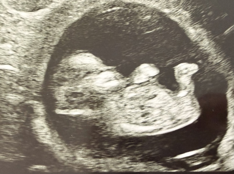 Early gender guesses after our 12 week scan