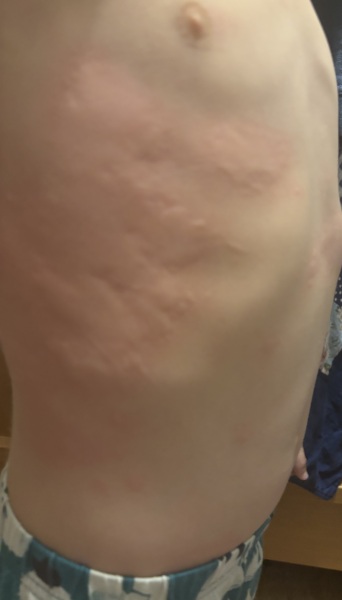 Quickly spreading itchy rash on my three-year-old