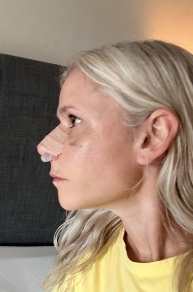 I’ve just had a nose job in Turkey - AMA