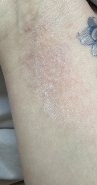 Tattoo allergic reaction? Help:(