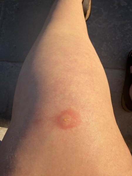To ask for help with an infected bug bite?!