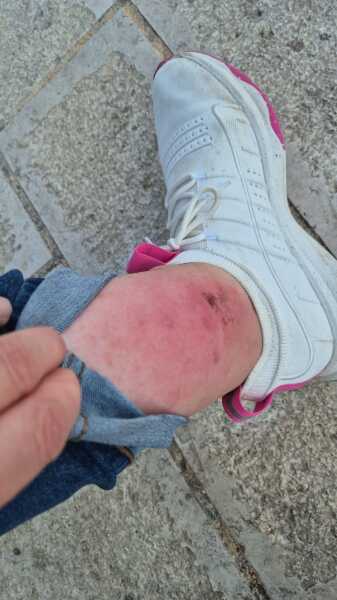 Has anyone had an insect bite go like this?