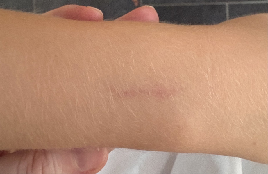 Dog Bite Advice
