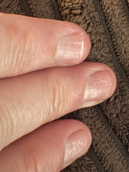 Nail pitting , joint pain - anyone else?