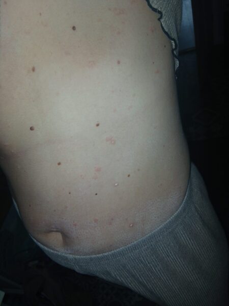 Skin rash