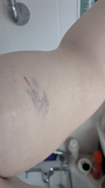 Should my blood pressure be retaken with a properly fitting cuff?
