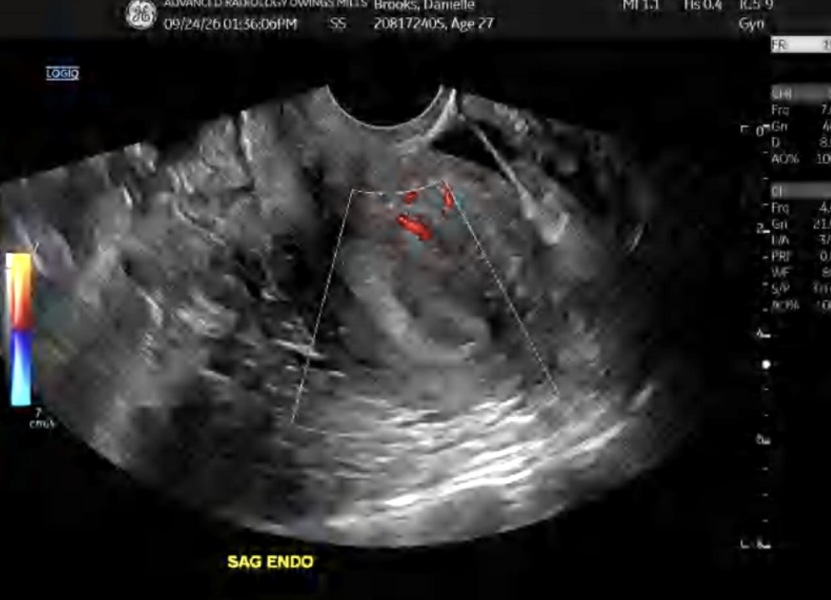 Unsure how to interpret pelvic sonogram and transvaginal ultrasound report